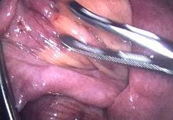 of IO Small bowel healthy Peterson s space hernia