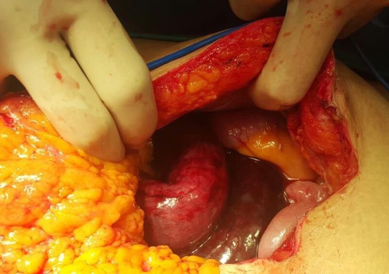 Diagnostic laparoscopy, laparotomy and resection of gangrenous bowel Intra-op findings: Loop of small bowel caught in small bowel mesenteric defect causing gangrenous segment Gangrenous bowel was
