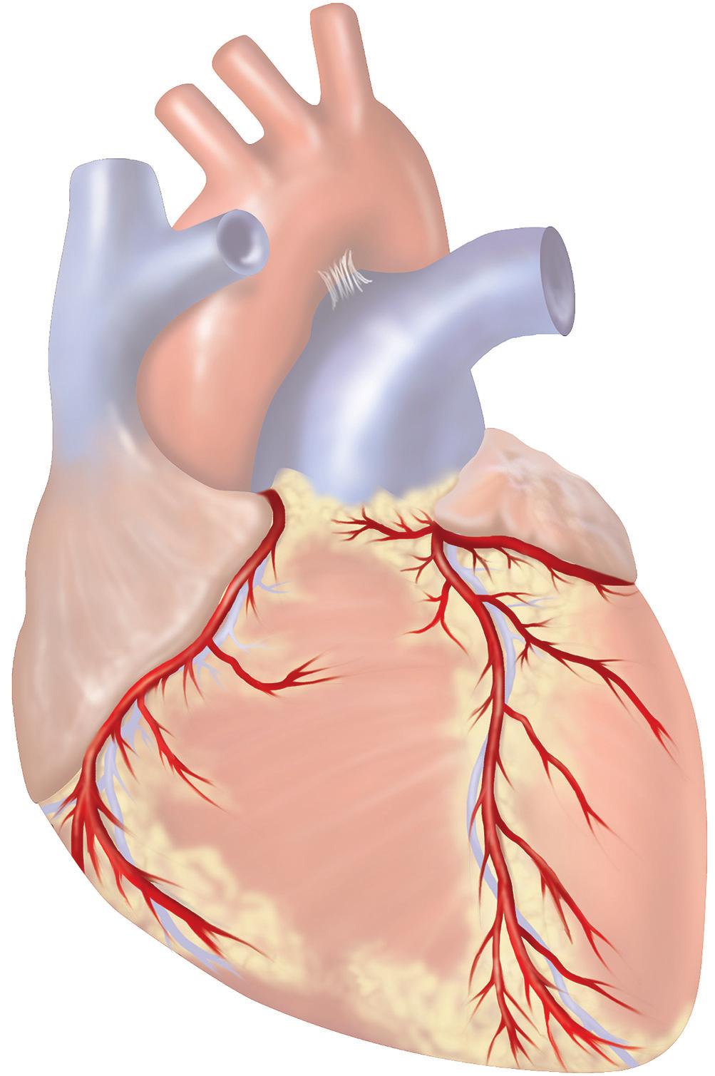 What is a percutaneous coronary intervention?