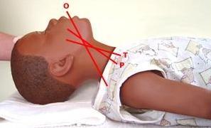 Proper airway positioning Proper positioning aligns the oral