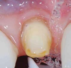 Photos courtesy of Dean Elledge, DDS, MS Wichita State University, AEGD Loose Tissue For difficult