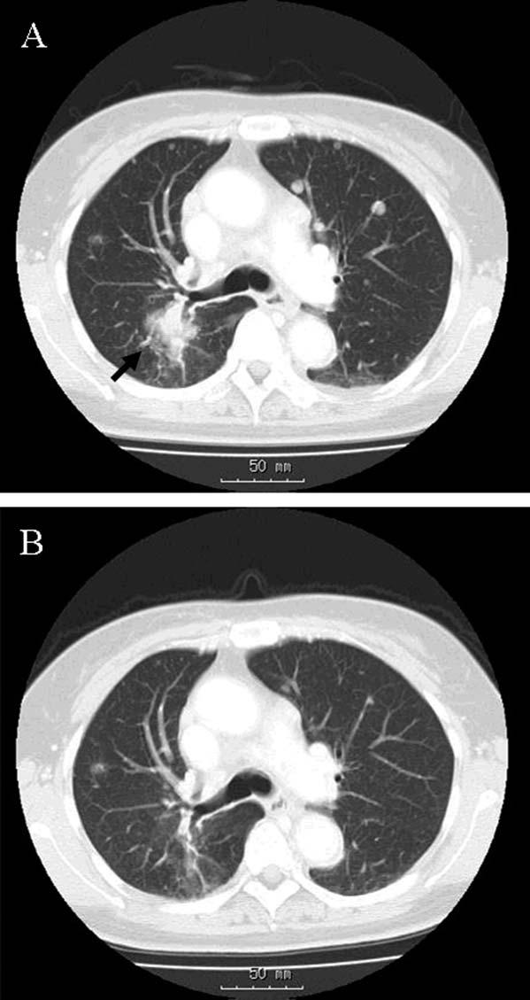 Radiologic Findings in Lung Cancer/Togashi et al Figure 2.