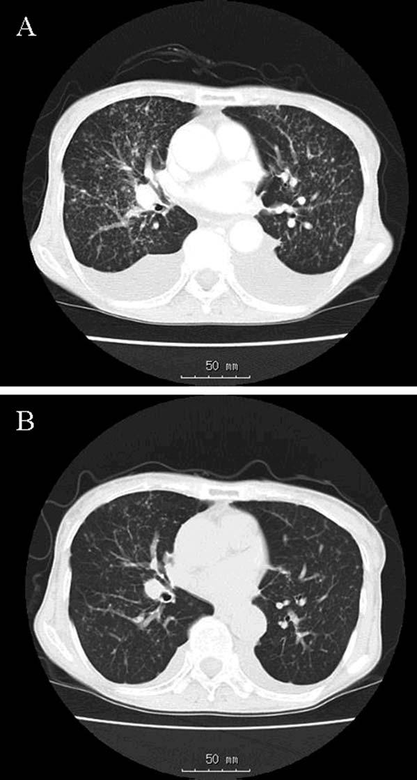metastases. (A) Multiple nodules are distributed diffusely throughout the lungs and a primary lesion in the right upper lobe (arrow). The nodules are not uniform in size.