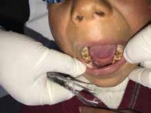 The level of dental disease we found in the Bolivian children was astonishing: More than half of the children examined complained of daily pain from