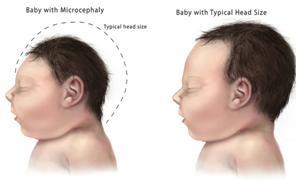 2. Effect of Zika in Pregnant Women The difficulty with Zika is that many people who get the virus are never diagnosed yet it might still potentially damage fetuses.