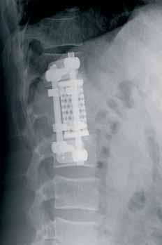 The VBOSS TM System is intended to replace a vertebral body or an entire vertebra in the thoracolumbar spine (T1-L5) to replace a collapsed, damaged or unstable vertebral body or vertebra due to