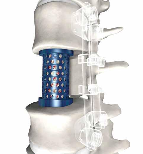 The supplemental internal fixation systems that may be used with VBOSS include, but are not limited to, Stryker Spine plate or rod systems (Xia Spinal System, Spiral Radius 90D and Trio TM ).