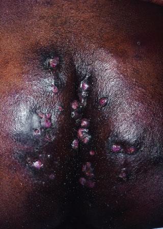 Hidradenitis suppurativa Severe scarring on the buttocks, inflammatory painful nodules with fistulas and draining sinuses. When the patient sits down, pus will squirt from the sinus openings.