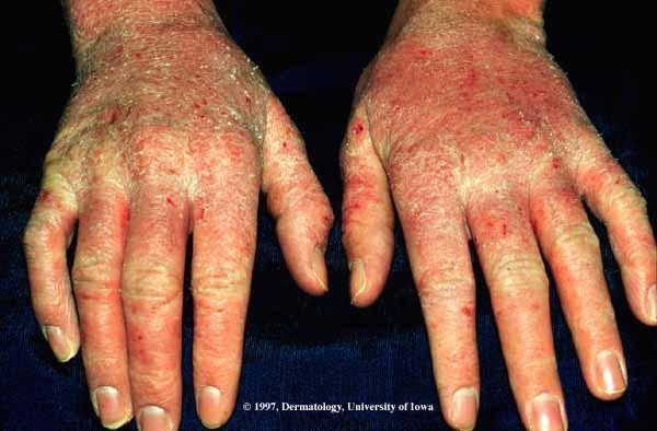 Eczema Dryness of the epidermis Usually seen on