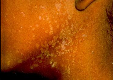 brown Typically occurs on the back, neck, chest, shoulders More