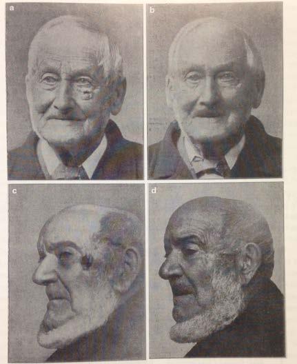 History of Radiotherapy for Skin (1902) 93 y/o with rodent ulcer pre and 2 yrs post XRT; 83 y/o with