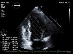 dysfunction (E/e 13 and a mean e septal and lateral wall <9