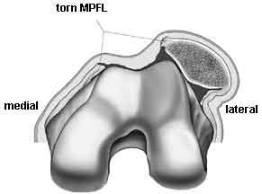 Contraindications to MPFL No medial laxity Chronic pain PF OA Chronically dislocated patella