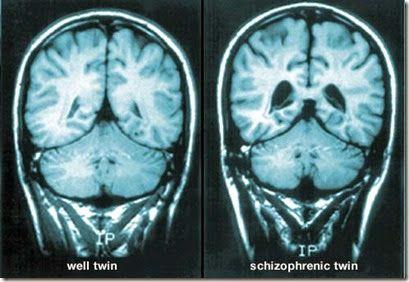 Schizophrenia Split Mind Schizophrenia is classified as disorganized thinking, distorted perception, and inappropriate emotions and actions.