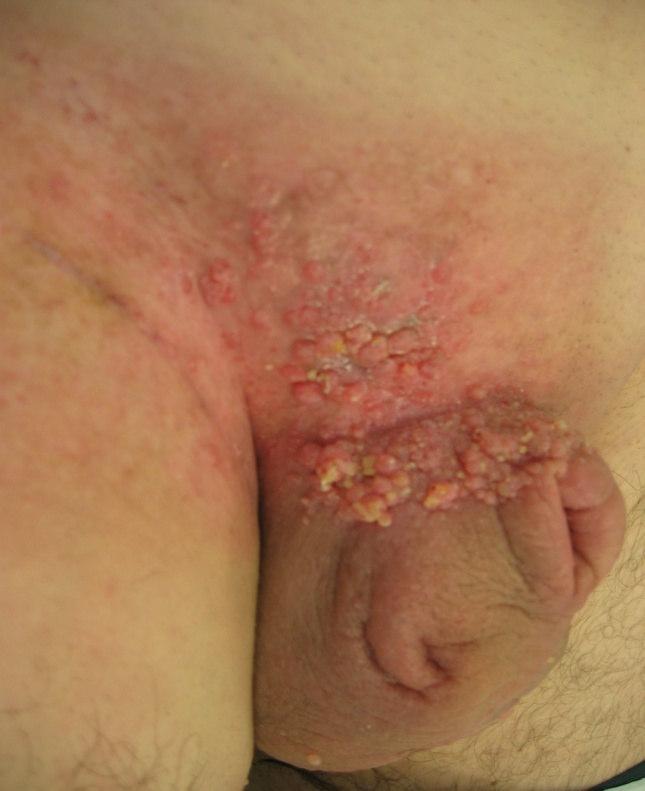 FIGURE 2. Replacement of diseased inguinal skin with a VRAM flap and penile shaft skin with a partial-thickness skin graft.