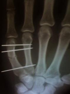 34 Figure 1: The most distal wire was placed through the fractured border metacarpal to the intact central one just proximal to the collateral recess of both bones and has also avoided tethering the