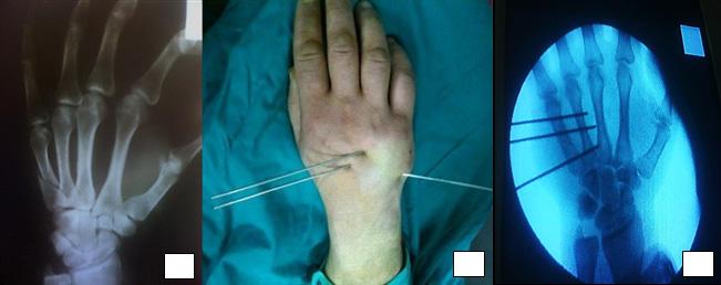 C. The resultant reduction on the image intensifier. All wires were left protruding from the skin after being bent.