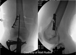 Distal 1/3 Fxs Bumps on Triangle Fracture Reduction Tool