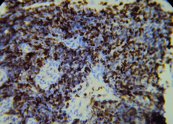 Pavithra et al. A-607 Fig. 5: Tumor cells of SCLC show strong nuclear immunostaining with Ki67. Discussion Lung cancer is the leading cause of cancer related morbidity and mortality.