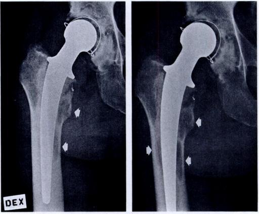 Figure 2 - Radiograph of a 70-year-old man two years after total hip replacement for primary osteoarthritis.