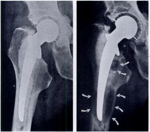 AGGRESSIVE GRANULOMATOUS LESIONS AFTER HIP ARTHROPLASTY 573 Fig. 6 Fig.7 Fig. 8 Figure 6 - A 53-year-old man three months postoperatively.