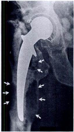 The hip was painful, but at revision, the prosthesis was stable in its new position.