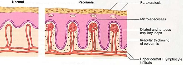 Psoriasis severity has been noted to fluctuate with hormonal changes. Disease incidence peaks at puberty and during menopause.
