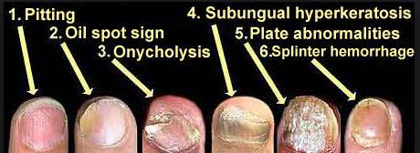 Clinical Presentation of Other Types of Psoriasis 1. Inverse psoriasis.