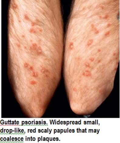3. Pustular psoriasis: Pustular Psoriasis may be localized or