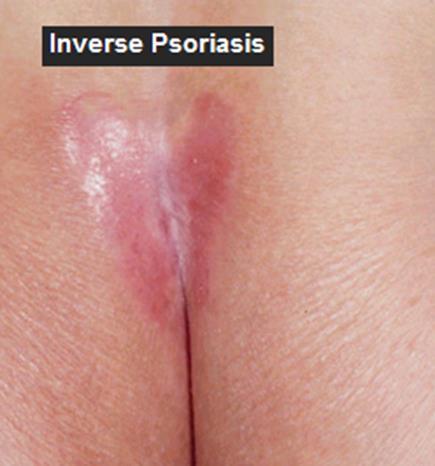 therapy. Pustular psoriasis is an uncommon form of psoriasis.