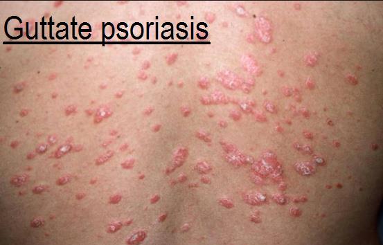 bumps on the skin that are filled with pus (pustules). 5.
