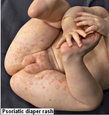 6. Psoriatic diaper rash is the most common type of psoriasis in children under 2 years old.