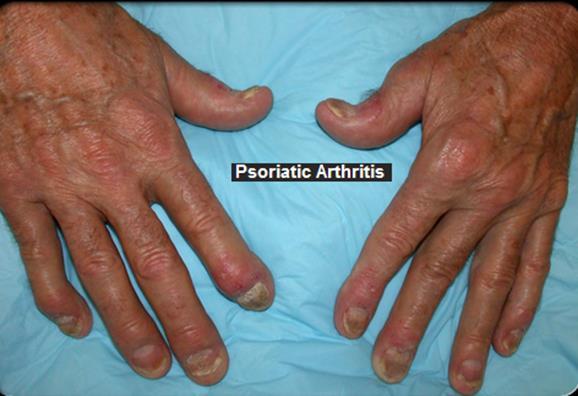 Psoriatic arthritis is a specific condition in which a person has both psoriasis and arthritis.