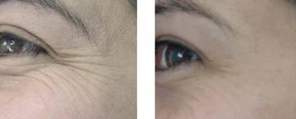 aged 4 years old and more showed a decrease of their wrinkles. 47 years old L-Glutamyl-amidoethylimidazole % Preservative.4% Water (sqf ) % Colorless liquid.