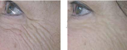 skin tonicity wrinkle reduction does not show any toxicity.