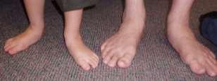 COMMON Forefoot INJURIES IN TEENS Without Arch Posterior Tibial Tendon Dysfunction (PTTD) is a condition caused by changes in the tendon, impairing its ability to support the arch and resulting in