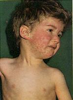 Measles Symptoms Incubation period: ~14 days Prodrome: fever, cough, coryza, conjunctivitis Rash starts on