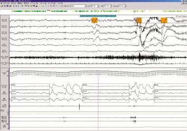 The gold standard for diagnosis of SAHS Polysomnography (PSG) Overnight monitoring of sleep
