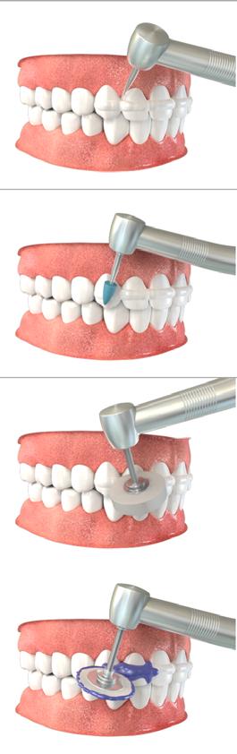 This step will ensure patient s comfort as well as esthetics and oral hygiene Following sequence