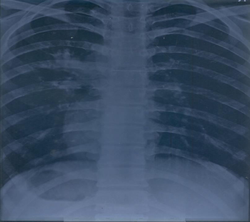 Case 2 19 year male being treated elsewhere diagnosed as Pulmonary TB H 300 R 450 E 800