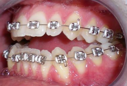 Fiksni aparati se sastoje iz pasivnih i aktivnih elemenata. Pasivni elementi se fiksiraju za zube i tako primenjenu silu prenose na zube. Aktivni elementi su izvor sile neophodan za pomeranje zuba.