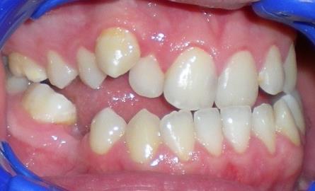 Pregled literature Ortodontska terapija fiksnim aparatima podrazumeva fiksiranje bravica na svaki zub pojedinaţno, pri ţemu su bravice povezane