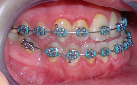 Negativna strana fiksnih ortodontskih aparata je ta što su konstantno prisutni u ustima onemogušavajuši adekvatnu oralnu higijenu i izazivajuši
