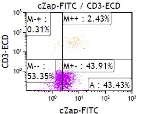 COMMENTS: Correlation with comprehensive evaluation of clinical and pathological findings is recommended. FLOW CYTOMETRY: CD19+ B cell lymphoma, ZAP-70 + (44%).
