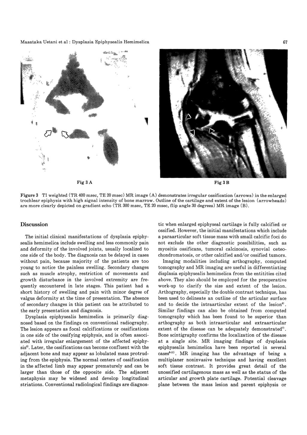 Fig 3 A Fig 3 B Figure 3 T1 weighted (TR 400 msec, TE 20 msec) MR image (A) demonstrates irregular ossification (arrows) in the enlarged trochlear epiphysis with high signal intensity of bone marrow.