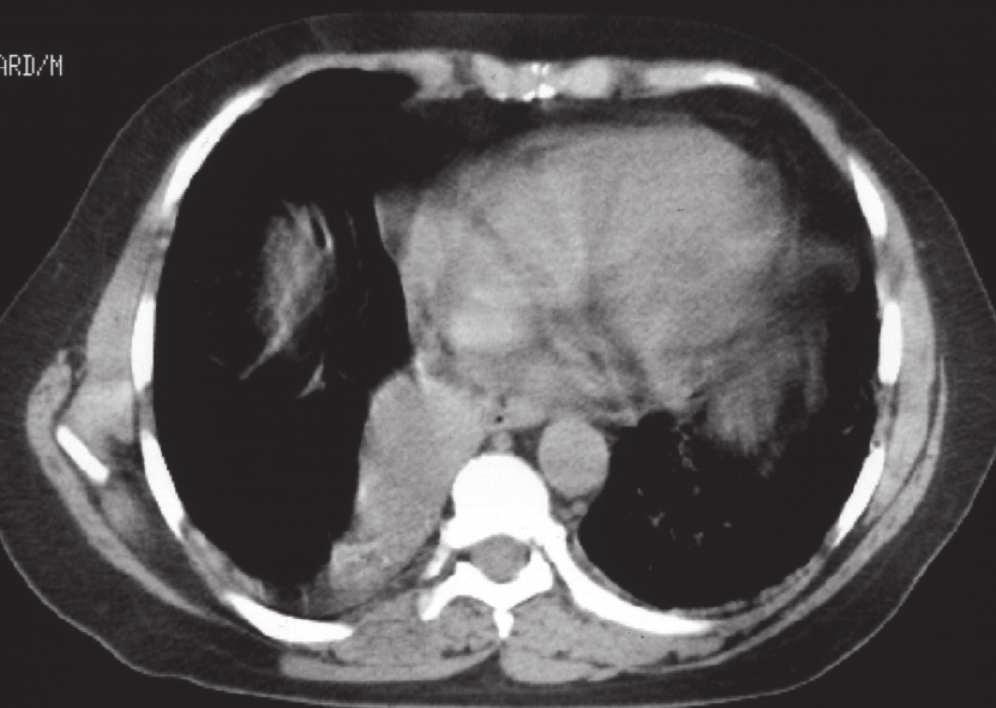 Peculiarities of non-small cell lung cancer local extension radiological assessment 121 Fig. 7. Right lower lobe carcinoma with atelectasis. Little pleural thickening can be noticed (arrow).