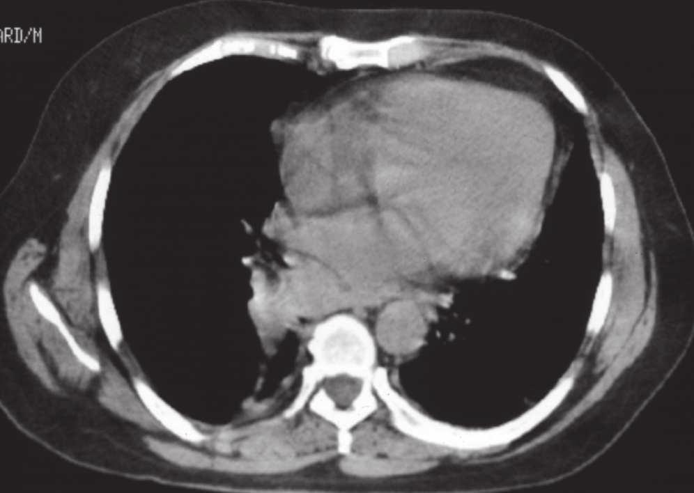 CT and bronchoscopy determined left lower lobe squamous carcinoma and pleural fluid. Operation revealed T4 squamous carcinoma with pericardium invasion.