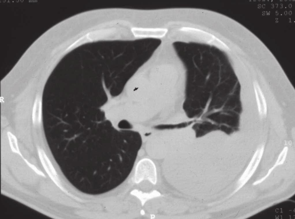 Operation revealed lower lobe adenocarcinoma with pleural carcinosis and malignant pleural fluid In two cases Figures 6 and 7 showed very similar radiogical presentation but revealed different