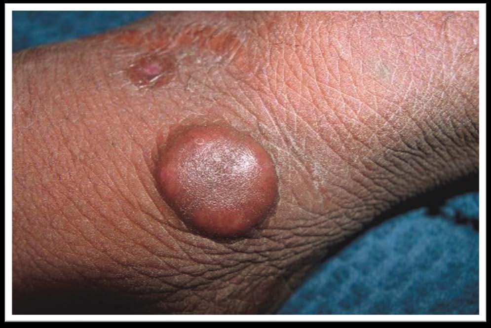 Discussion Erythema elevatum diutinum (EED) is a rare, chronic, skin disorder with a