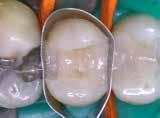 Incremental layers of opaque dentine